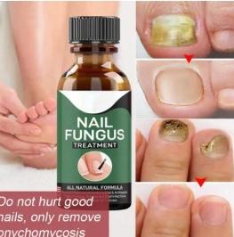 100 % working Fast Nail Fungal Treatments Nail Repair Essences Serum Care Treatments Foot Nail Fungus Removal Gel Paronychia Onychomycosis