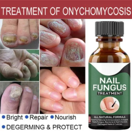 100 % working Fast Nail Fungal Treatments Nail Repair Essences Serum Care Treatments Foot Nail Fungus Removal Gel Paronychia Onychomycosis